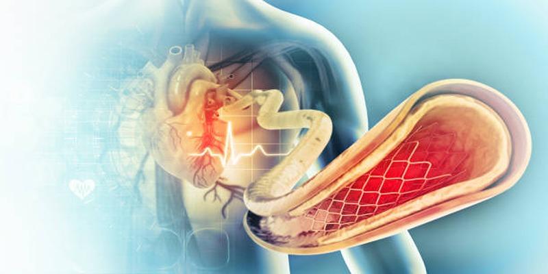 SCAD in Athletes: Key Facts About This Heart Condition